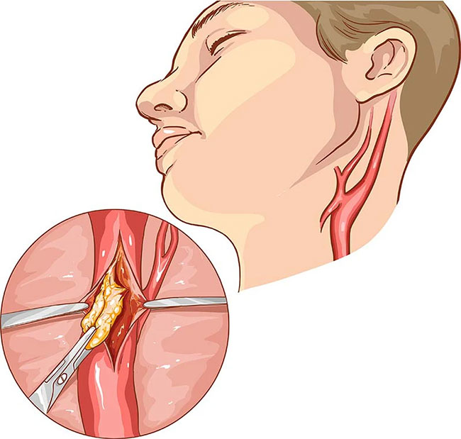 Hẹp động mạch cảnh là tình trạng xảy ra khi động mạch này (ở cổ) bị tắc nghẽn.