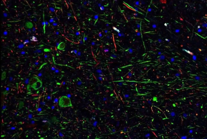 Tế bào thần kinh dopamine (màu xanh lá cây) trong não của các bệnh nhân Covid-19.