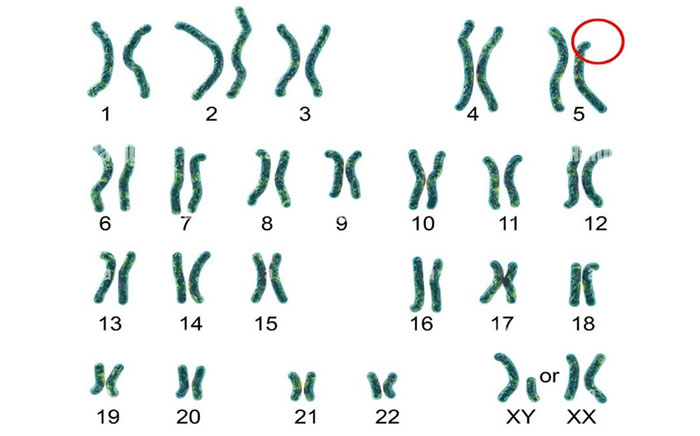 Hội chứng mèo kêu là do bất thường nhiễm sắc thể.