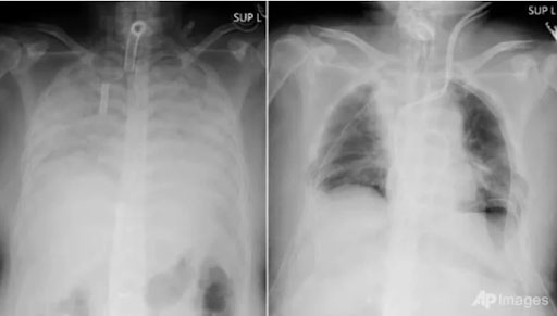 Hình ảnh X-quang phổi trắng.