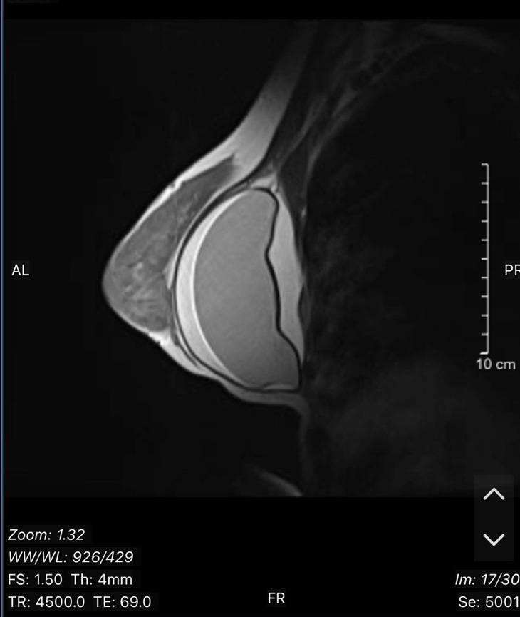 Hình ảnh MRI ngực trái của bệnh nhân vỡ túi ngực - Ảnh: Bác sĩ cung cấp