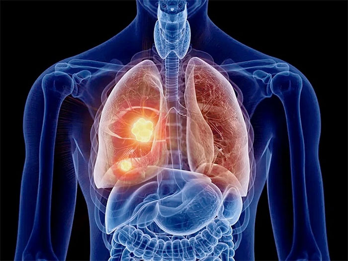 Ung thư phổi có xu hướng gia tăng