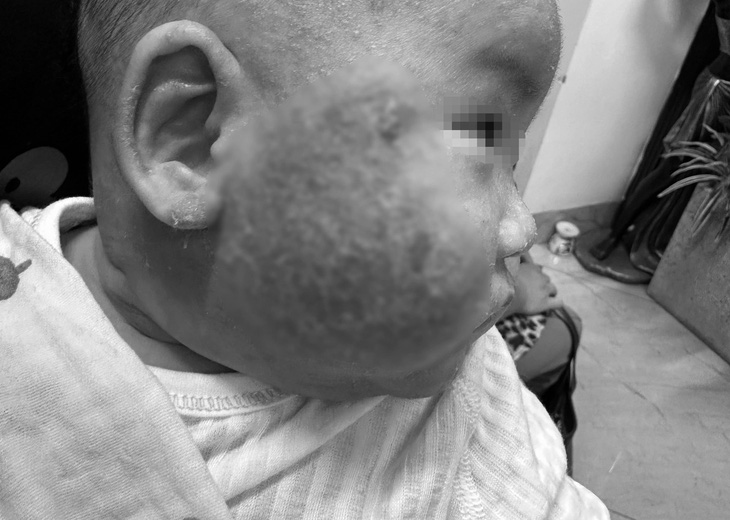 Bé 5 tháng tuổi đến thăm khám trong tình trạng  da bong tróc, chảy mủ - Ảnh: Bác sĩ cung cấp