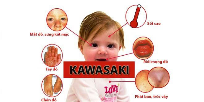 Một số biểu hiện của trẻ khi bị Kawasaki.