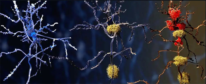 Tế bào não khỏe mạnh, tế bào bị Alzheimer và tế bào bị chết do microglia "nhấn chìm"