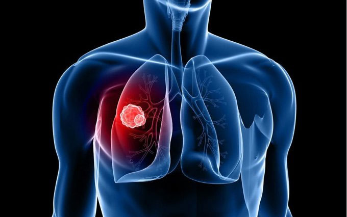 Minh họa khối u ung thư phổi.