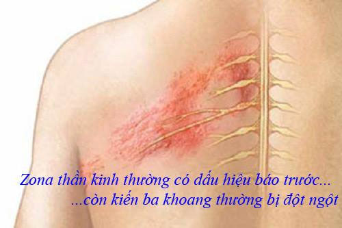 Vết thương do kiến ba khoang gây ra thường xuất hiện đột ngột