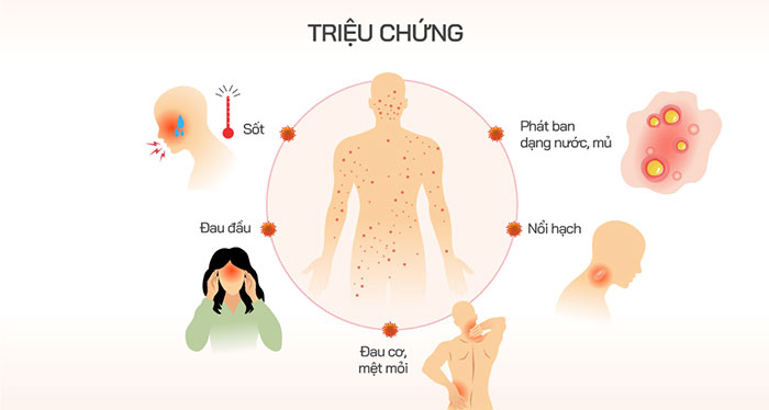 Các triệu chứng khi mắc đậu mùa khỉ.