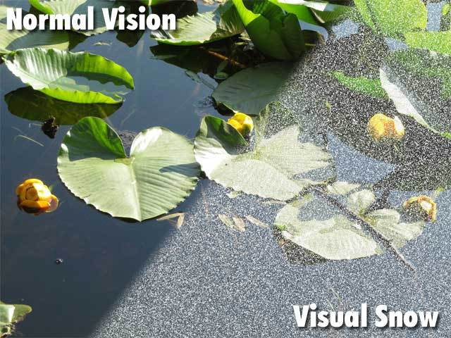 Tầm nhìn của người mắc chứng "visual snow" bị hạn chế hơn so với người bình thường.