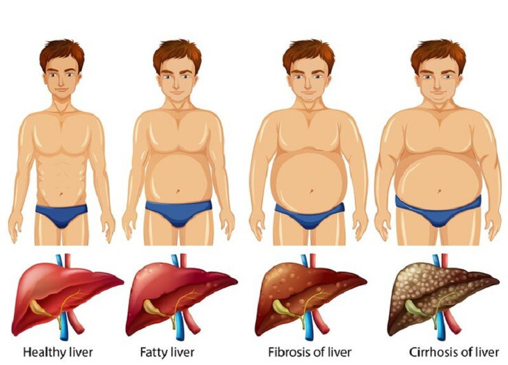 Chỉnh men gan cao theo cách tự nhiên tại nhà không dùng nhà thuốc Mai Tín - Ảnh 1.