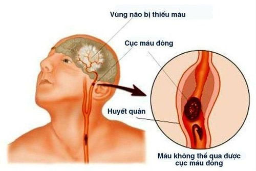 Bệnh nhồi máu não gây nguy cơ cao về đột quỵ não.