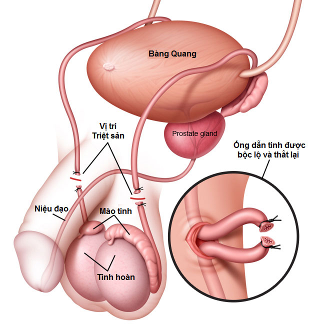 Thắt ống dẫn tinh giúp ngăn tinh trùng phóng ra.